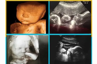 Sự phát triển của thai nhi 36 tuần tuổi