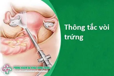 Nguyên nhân tắc vòi trứng