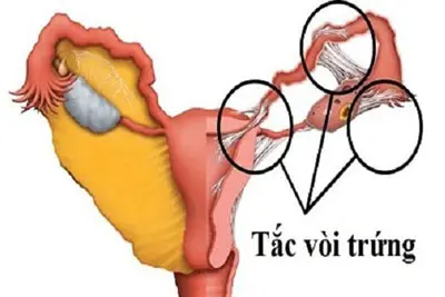 Tắc vòi trứng là gì?