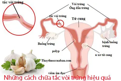 Những cách chữa tắc vòi trứng hiệu quả