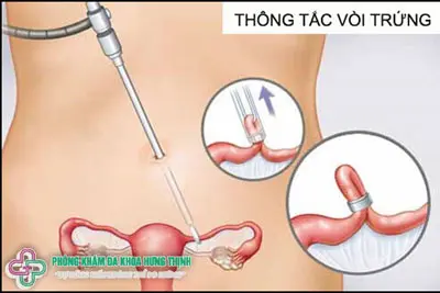 Điều trị tắc vòi trứng bằng phương pháp ngoại khoa