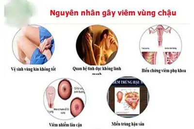 Nguyên nhân viêm vùng chậu