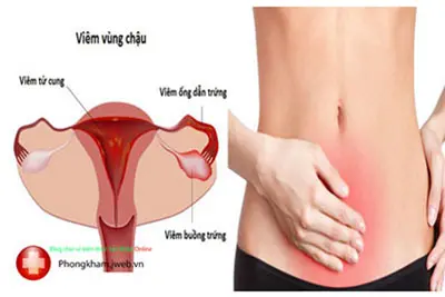 Triệu chứng viêm vùng chậu?