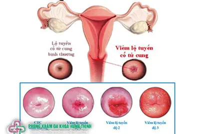 Viêm cổ tử cung là gì?