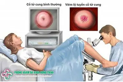 Cách chữa viêm cổ tử cung hiệu quả