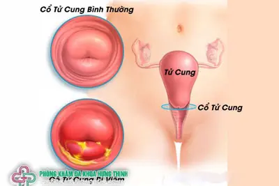Triệu chứng viêm cổ tử cung