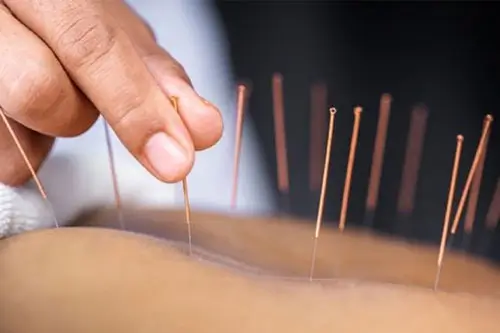 Phương pháp châm cứu