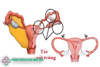 Tắc vòi trứng