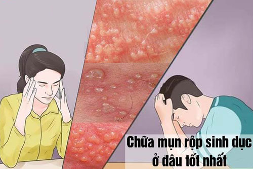 Khám chữa mụn rộp dinh dục ở đâu tốt nhất?