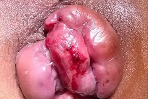 Hình ảnh bị trĩ ngoại giai đoạn 4