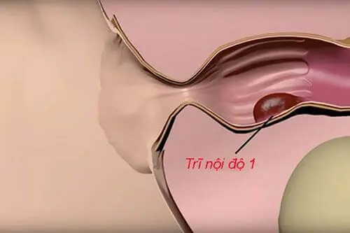 Hình ảnh bệnh trĩ nội giai đoạn 1