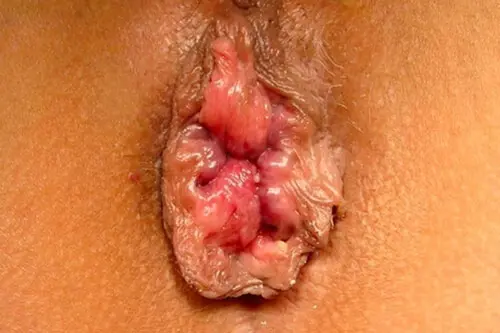 Hình ảnh bị trĩ ngoại giai đoạn 3