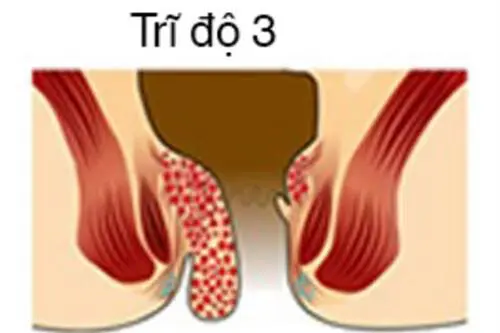 Hình ảnh bệnh trĩ nội giai đoạn 3