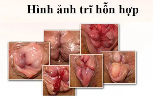 Hình ảnh của bệnh trĩ hỗn hợp