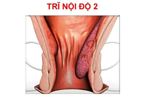 Hình ảnh bệnh trĩ nội giai đoạn 2
