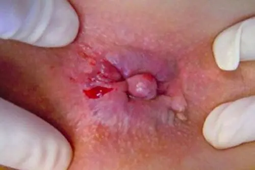 Hình ảnh bị trĩ ngoại giai đoạn 2