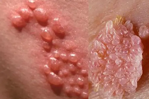 Nốt sùi mào gà có màu hồng hoặc da