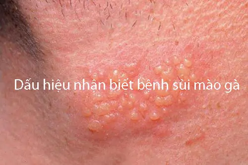Dấu hiệu bệnh sùi mào gà
