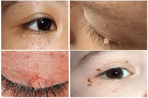 Sùi mào gà xuất hiện ở mắt