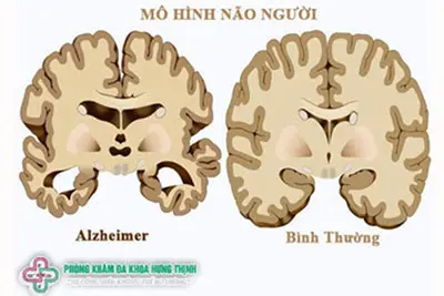 Nguyên nhân gây bệnh Alzheimer là gì?