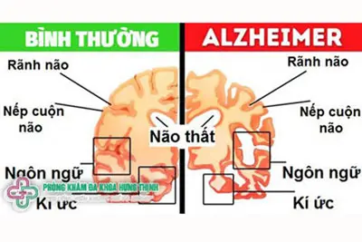 Dấu hiệu bệnh Alzheimer