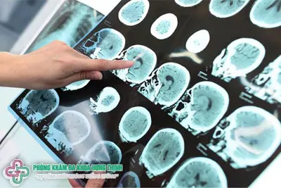 Cách chẩn đoán và điều trị bệnh Alzheimer