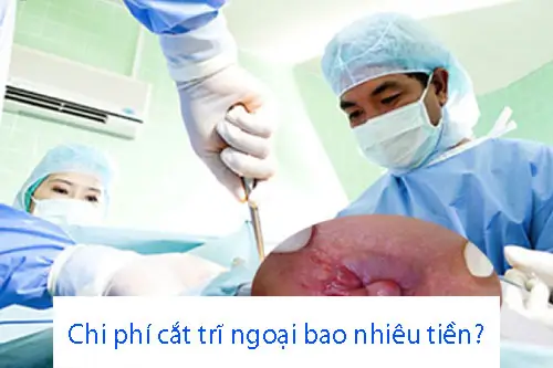 chi phí cắt trĩ ngoại bao nhiêu tiền?