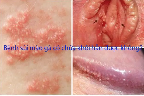 Bệnh sùi mào gà có chữa khỏi hẳn được không?