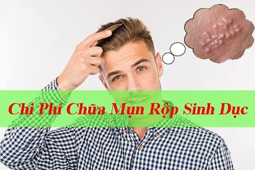 Chi phí chữa mụn rộp sinh dục