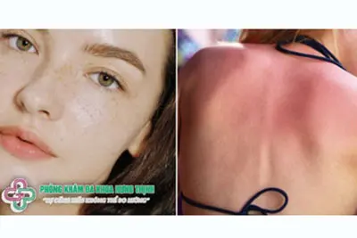 Thế nào là da bị cháy nắng?