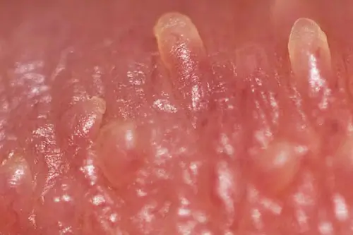 Bệnh gai sinh dục là gì?