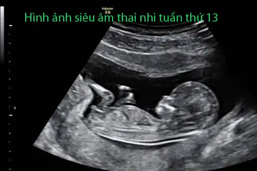Hình ảnh siêu âm thai 13 tuần tuổi