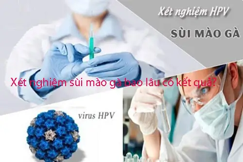 Xét nghiệm sùi mào gà bao lâu có kết quả?