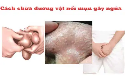 Cách chữa dương vật nổi mụn hiệu quả