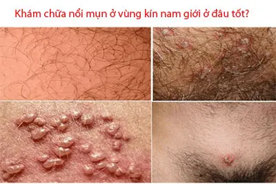Khám chữa nổi mụn ở vùng kín nam giới ở đâu tốt?