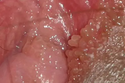 Hình ảnh nổi mụn do gai sinh dục