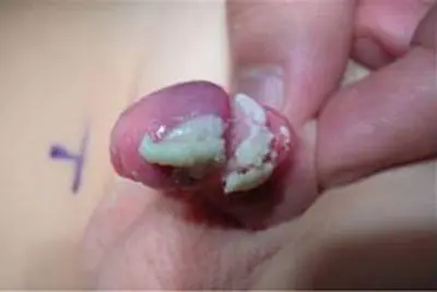 Hình ảnh do viêm bao quy đầu