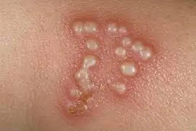 Hình ảnh do mụn rộp sinh dục