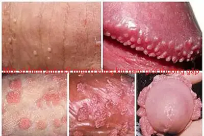 Một số hình ảnh nổi mụn ở vùng kín nam giới thường gặp