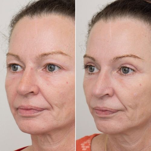 Eyelid Correction