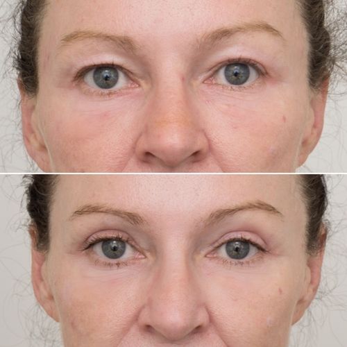 Eyelid Correction