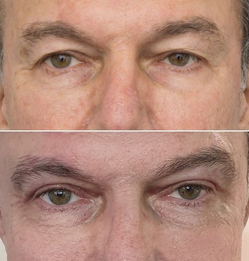 Eyelid Correction