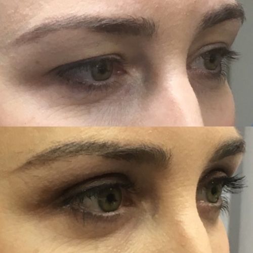 Eyelid Correction