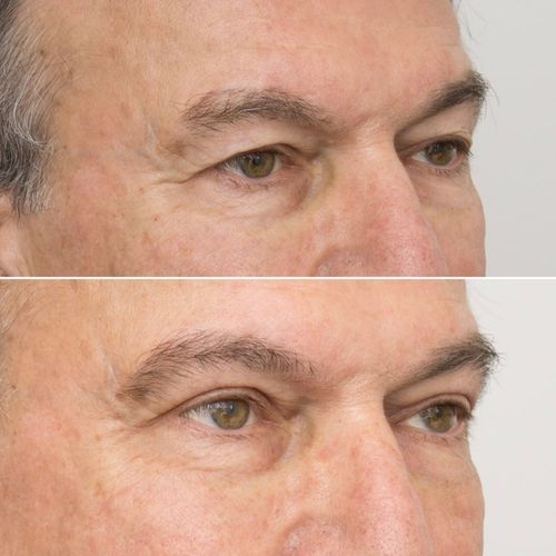 Eyelid Correction