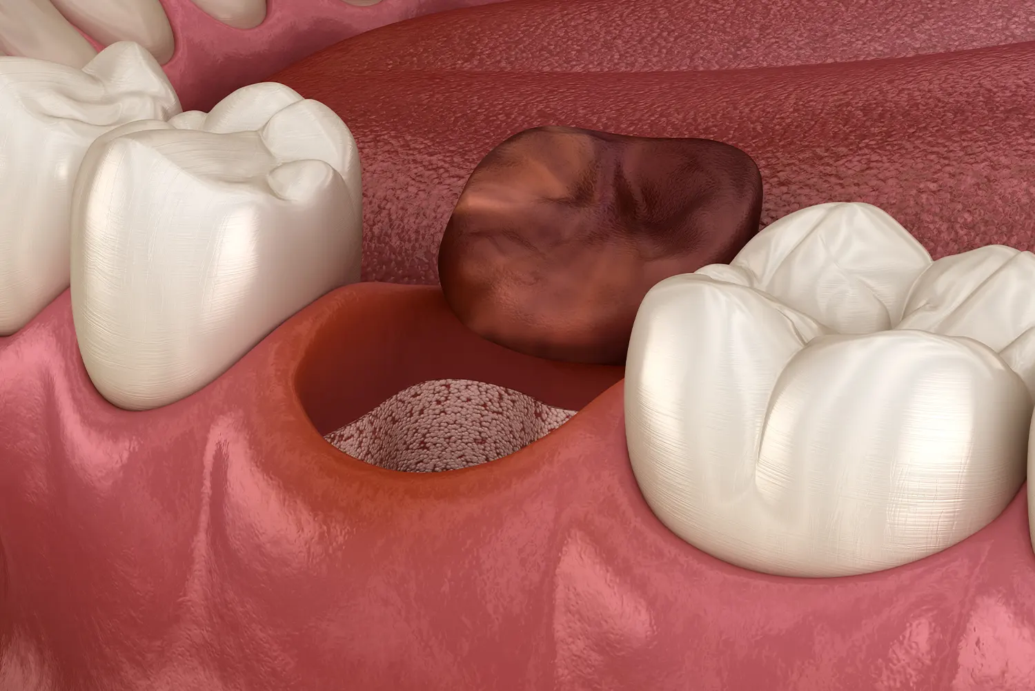 Oral Surgery Aftercare: Essential Steps to Avoid Dry Socket