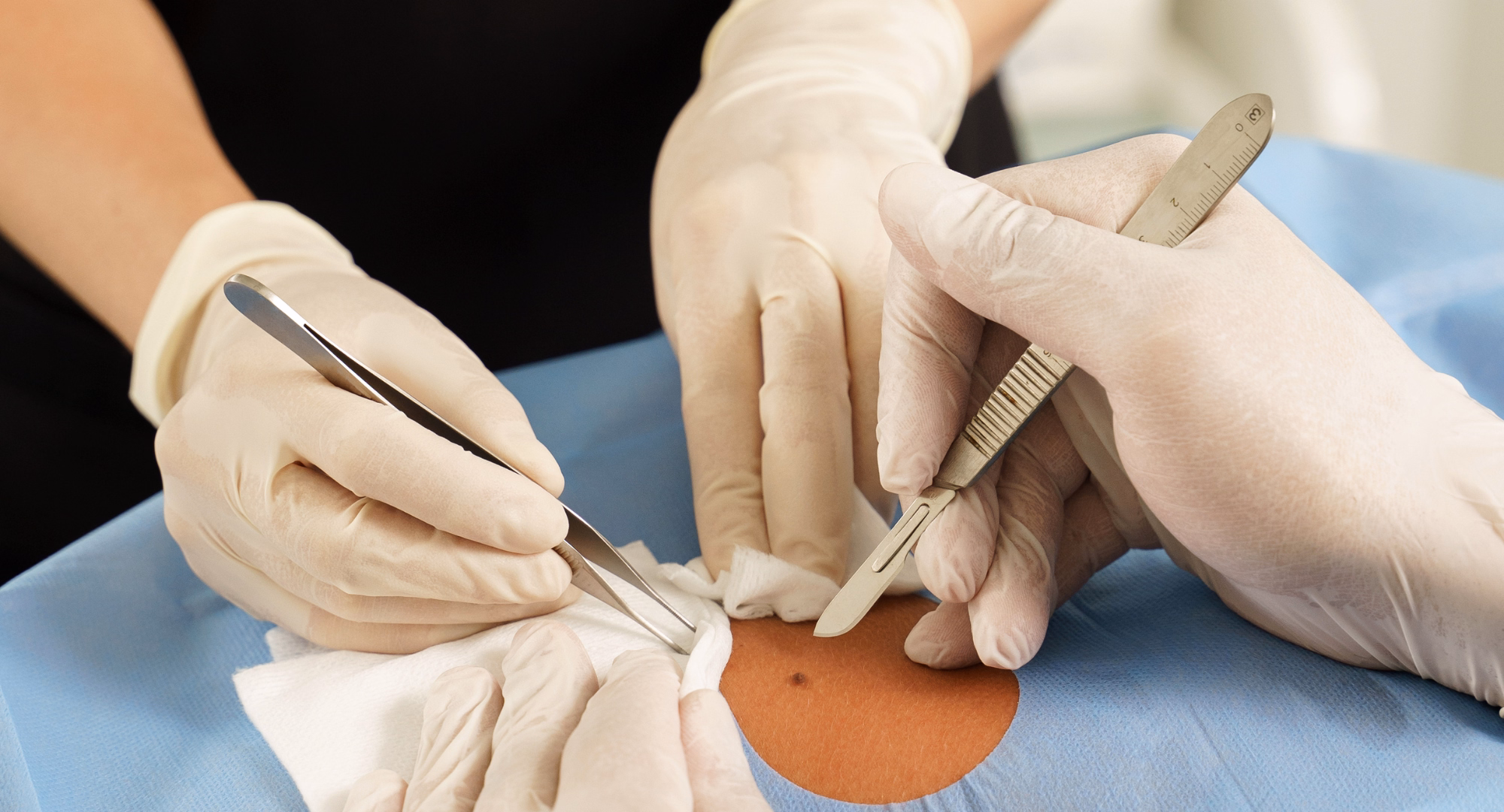 ambulantna kirurgija: uklanjanje madeža