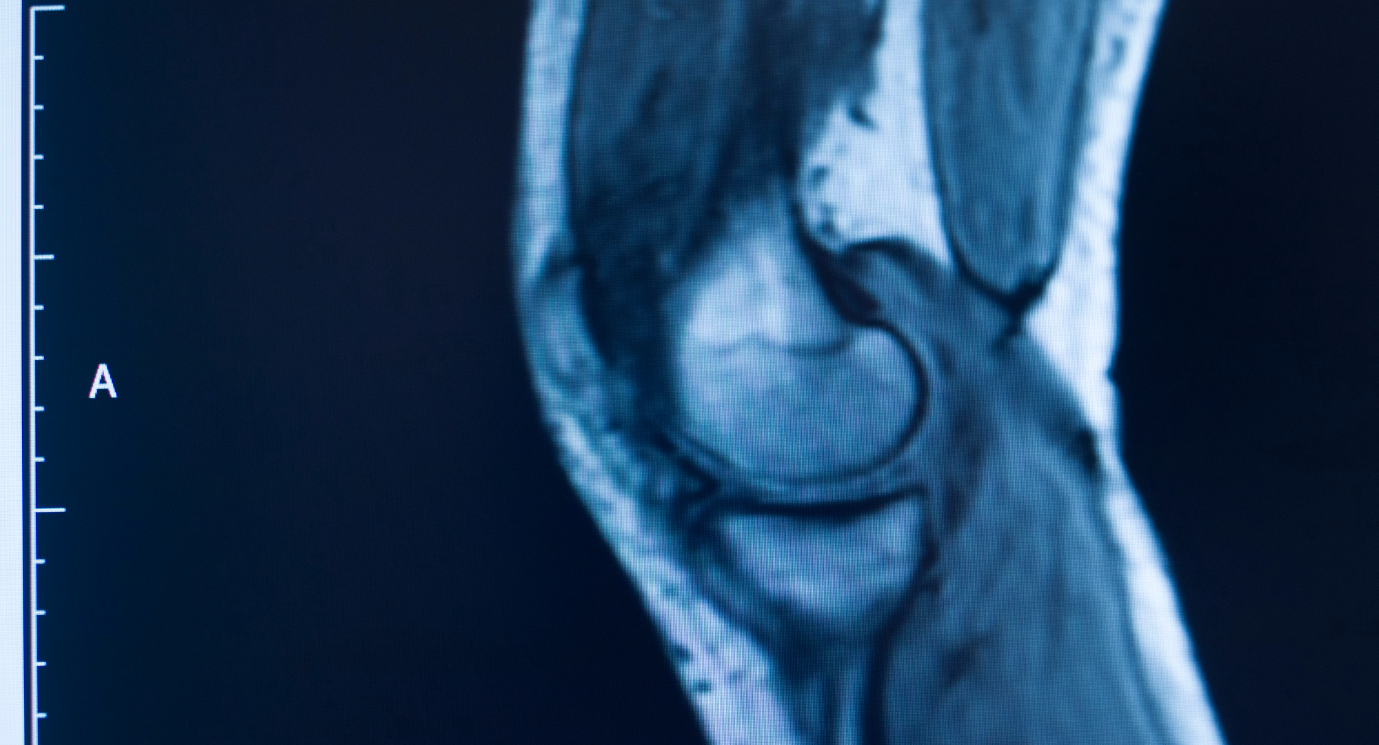 snimka ozljede koljena