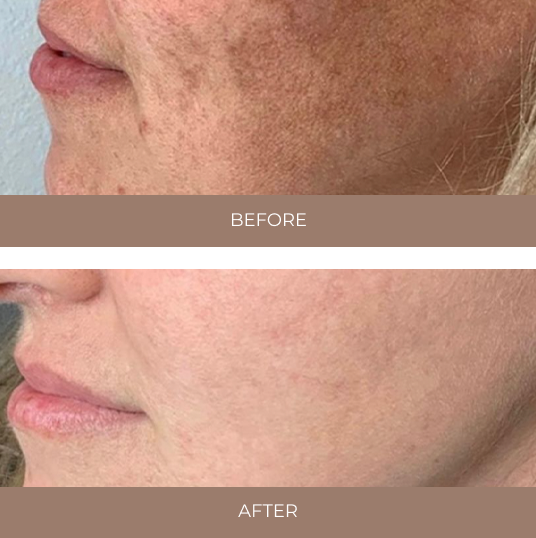Lumecca IPL Before and After Treatment Kent