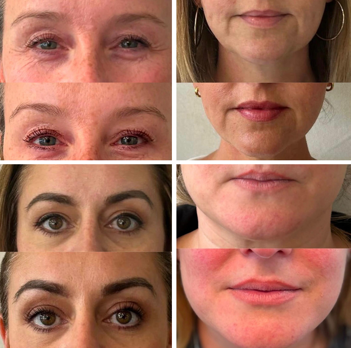 Full-Face Botox Treatment Kent 