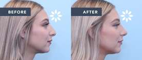 Ashley's rhinoplasty before and after — side profile view
